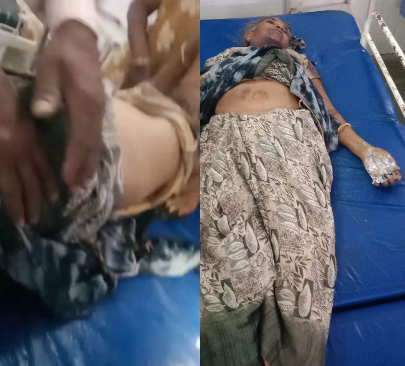 भूत-प्रेत भगाने के नाम पर अमानवीयता, तांत्रिक ने महिला के हाथों पर रखे जलते हुए कंडे
